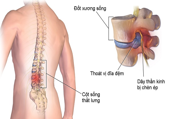 Cách massage lưng cho người thoát vị đĩa đệm được quan tâm